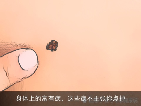 身体上的富有痣，这些痣不主张你点掉