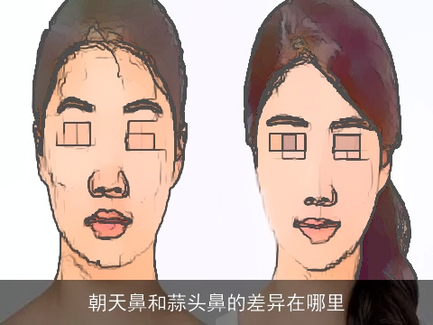 朝天鼻和蒜头鼻的差异在哪里