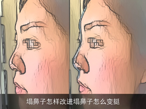 塌鼻子怎样改进塌鼻子怎么变挺