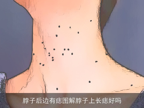 脖子后边有痣图解脖子上长痣好吗