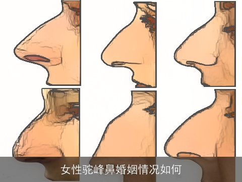 女性驼峰鼻婚姻情况如何