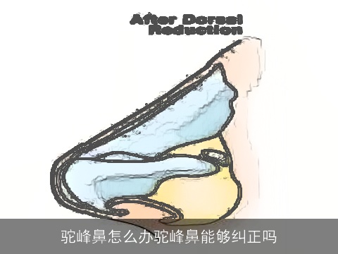 驼峰鼻怎么办驼峰鼻能够纠正吗