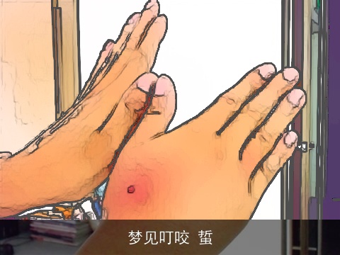 梦见叮咬 蜇